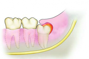 Pericoronitis-300x199