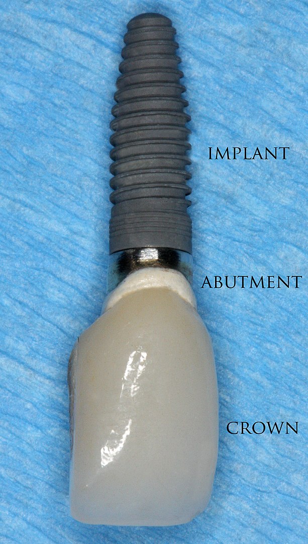 613px-Single_crown_implant