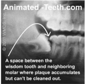 animated teeth pericoronitis food trap