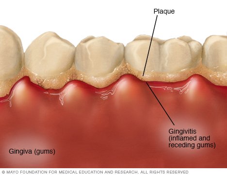 gingivitis diagram-1