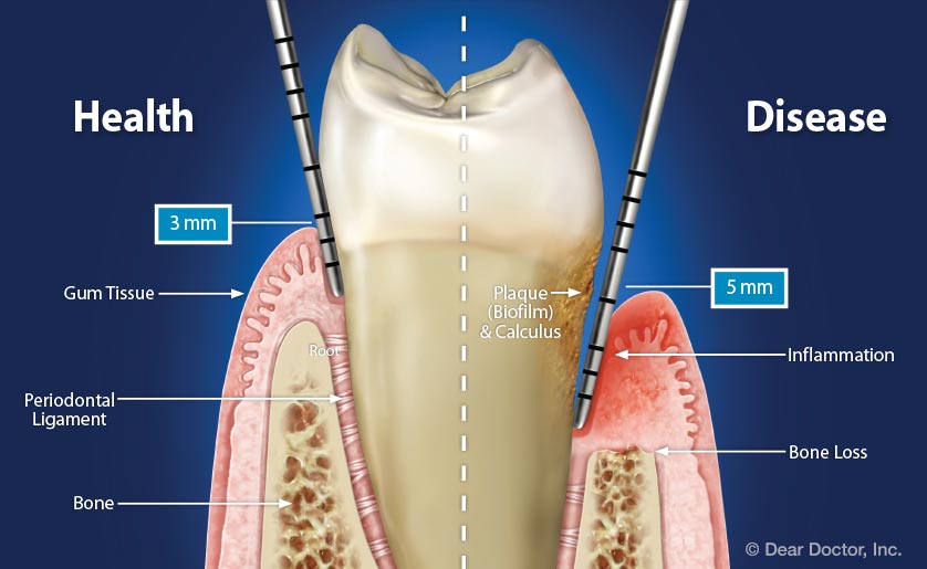 health-vs-disease-periodontal-pocket
