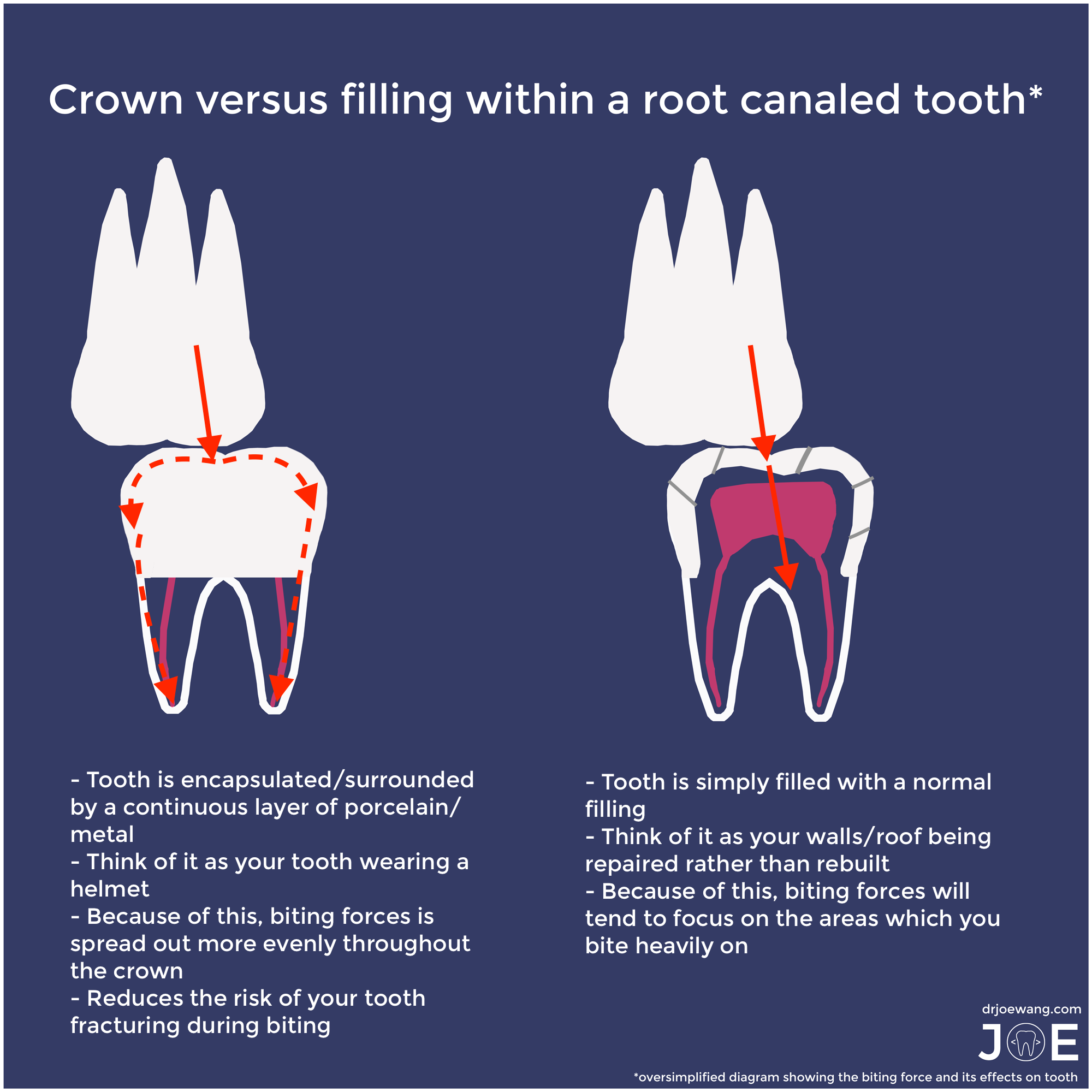 root-canal-filling-versus-crown
