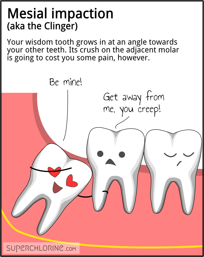 wisdom-teeth-types_mesial