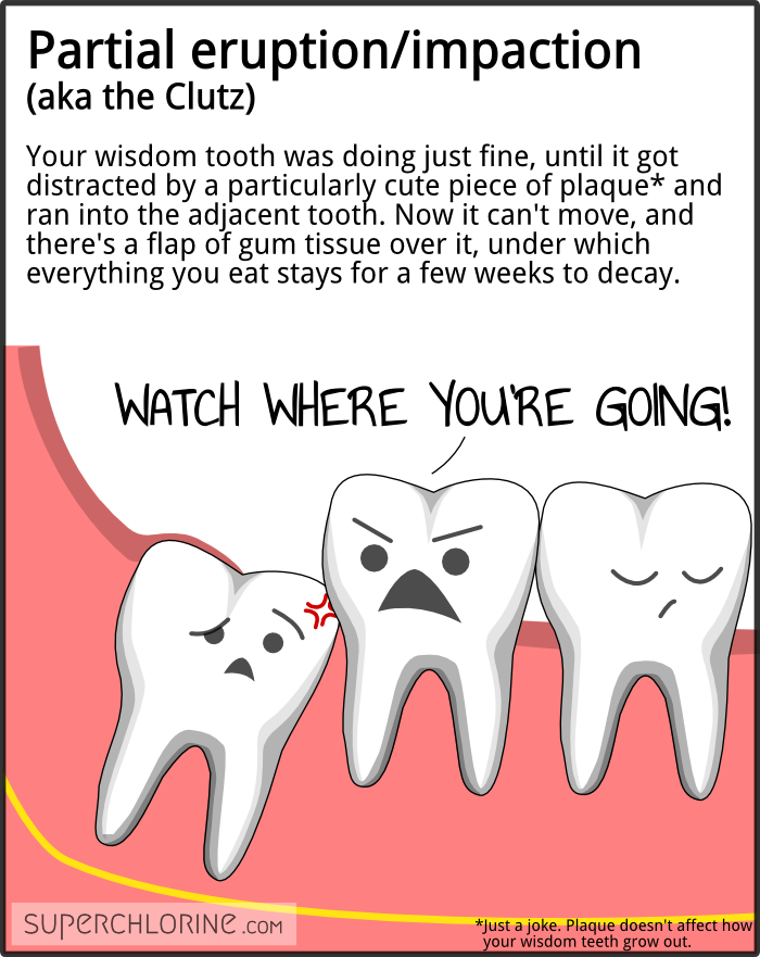 wisdom-teeth-types_partial-erupt